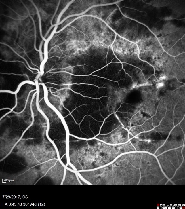 Blunt Trauma In Angioid Streaks Blunt Trauma In Angioid Streaks