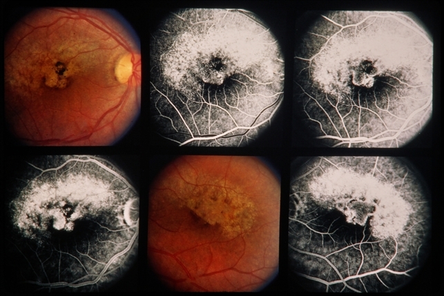 Coloboma: overview and more Coloboma - Retina Image Bank