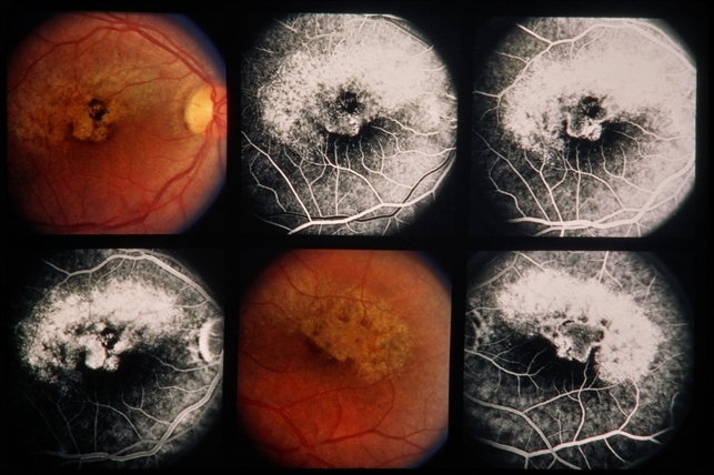 Coloboma - Retina Image Bank