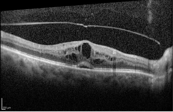 oct-cme-retina-image-bank