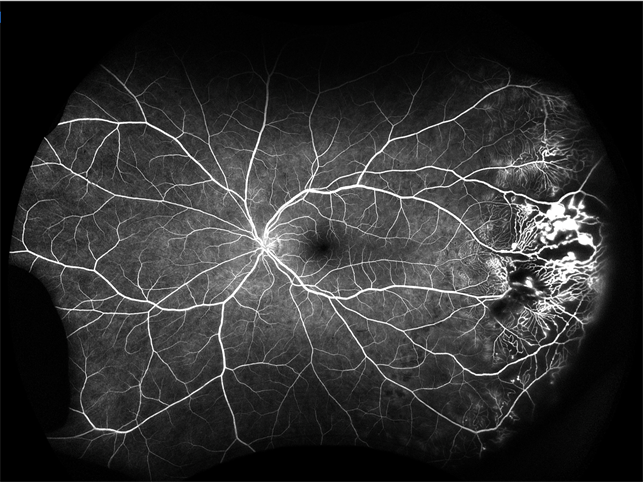 Optos retinal widefield Coats' Disease - Widefield Angiography - Retina Image Bank
