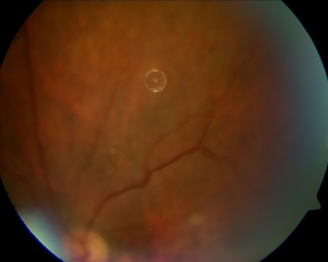 silicone oil droplet after avastin injection retina image bank avastin injection