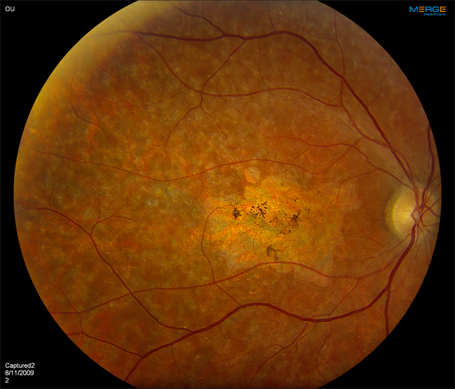 Stargardt Disease Retina Image Bank