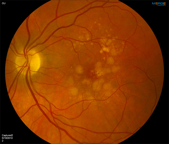 Age related macular degeneration with large drusen retina image bank