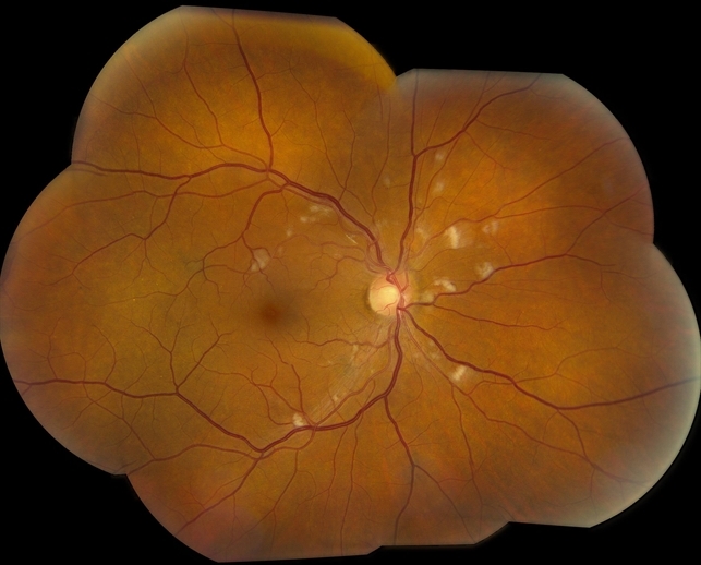 Hypertensive Retinopathy - Retina Image Bank