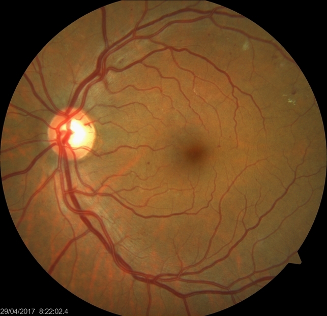 proliferative diabetic retinopathy