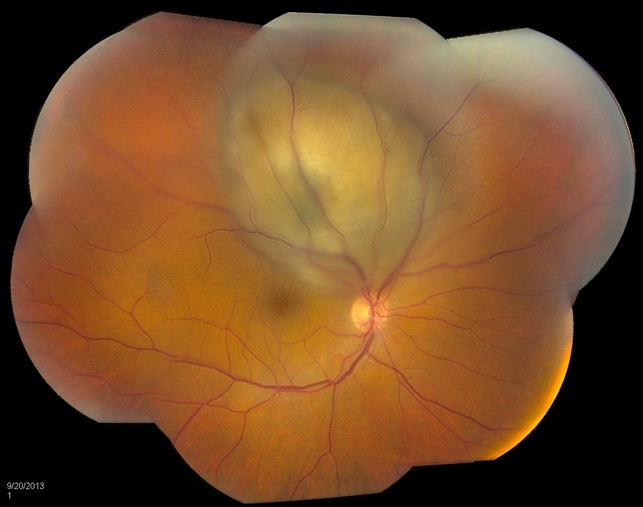 Choroidal Melanoma Retina Image Bank