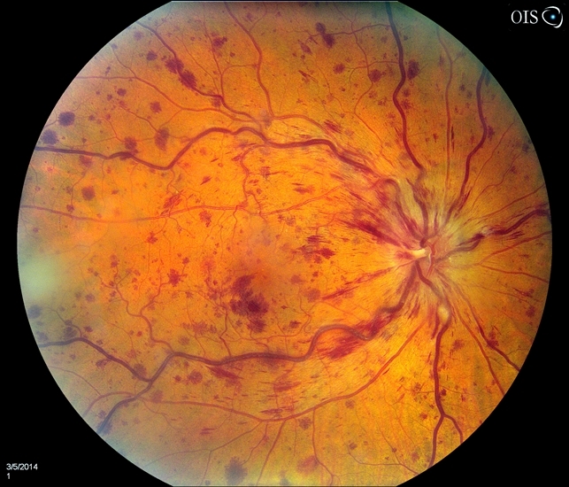 Central Retinal Vein Occlusion - Retina Image Bank