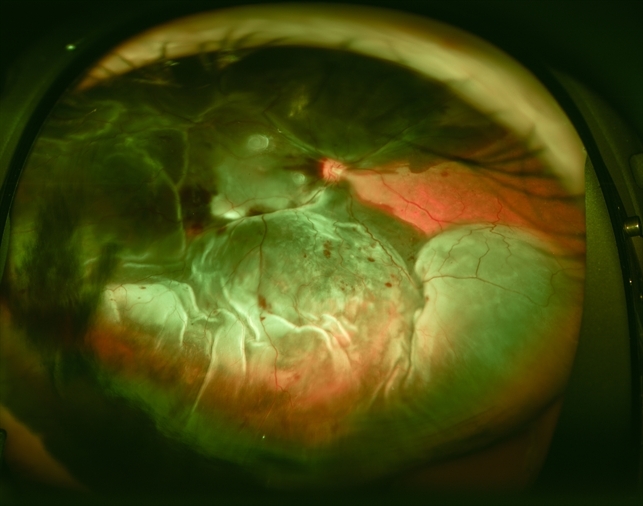 Massive Subretinal Hemorrhage Massive Subretinal Hemorrhage
