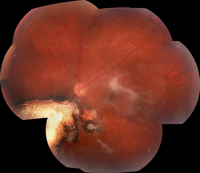 Toxoplasmosis Associated Epiretinal Membrane Toxoplasmosis Associated Epiretinal Membrane