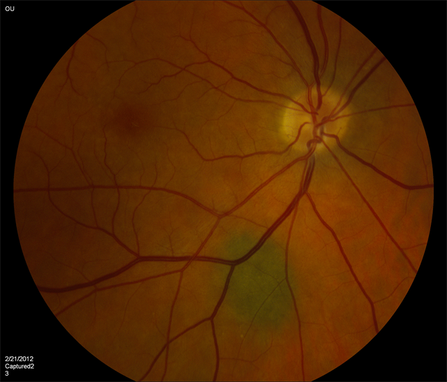 benign choroidal nevus os icd 10