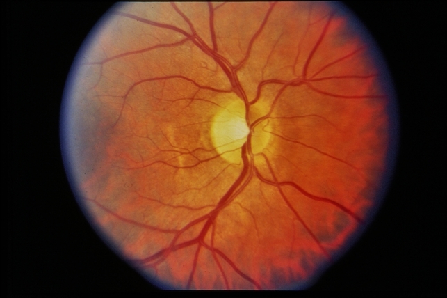 Choroidal Rupture Amp Lamellar Hole Retina Image Bank Choroidal Rupture Amp Lamellar Hole Retina Image Bank