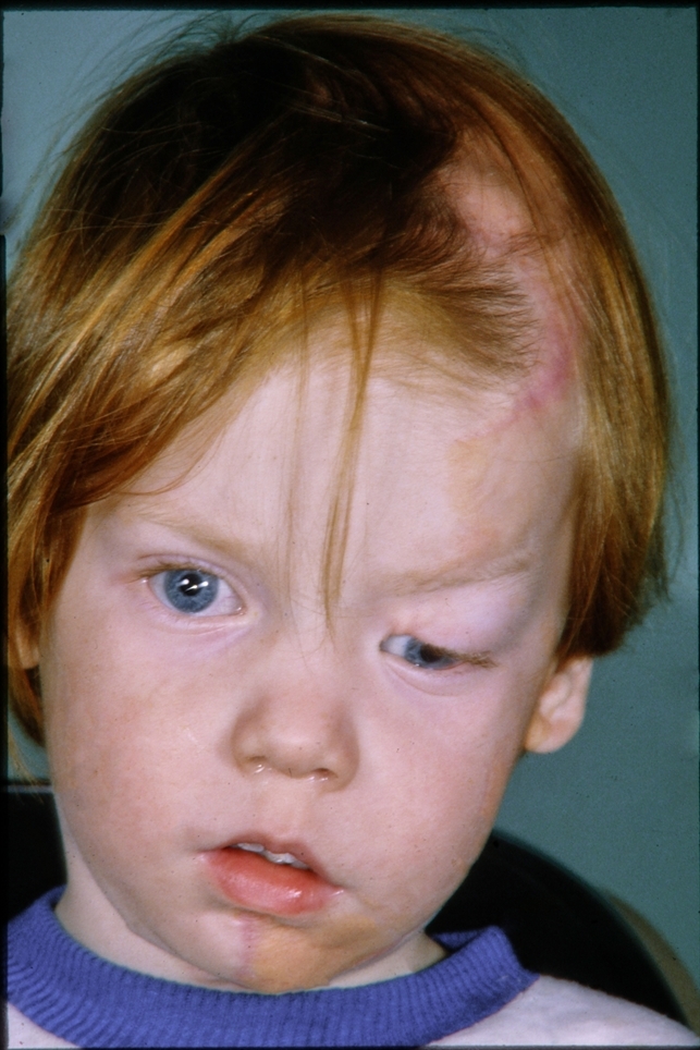 Linear Nevus Sebaceous Syndrome Retina Image Bank linear-nevus-sebaceous-syndrome-retina-image-bank