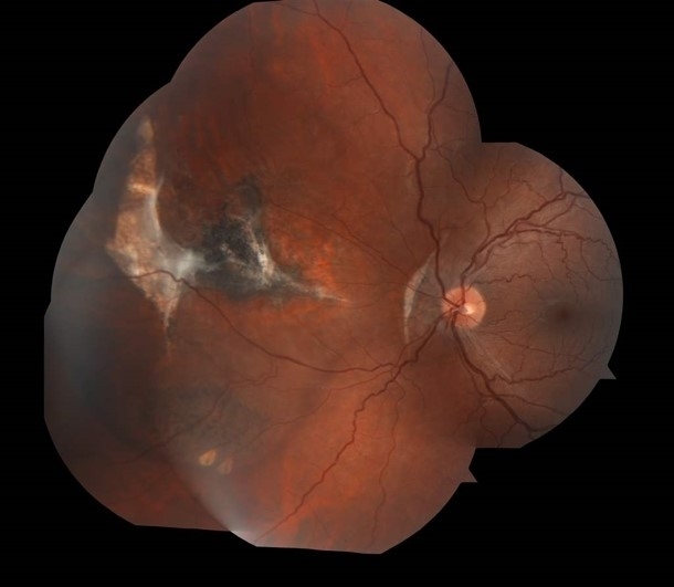 Retinitis Sclopetaria 6 Months Later Retinitis Sclopetaria 6 Months Later