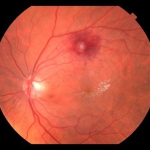 Rama laser pre macroaneurysm retina ruptured srf RAMA pre and post laser - Retina Image Bank