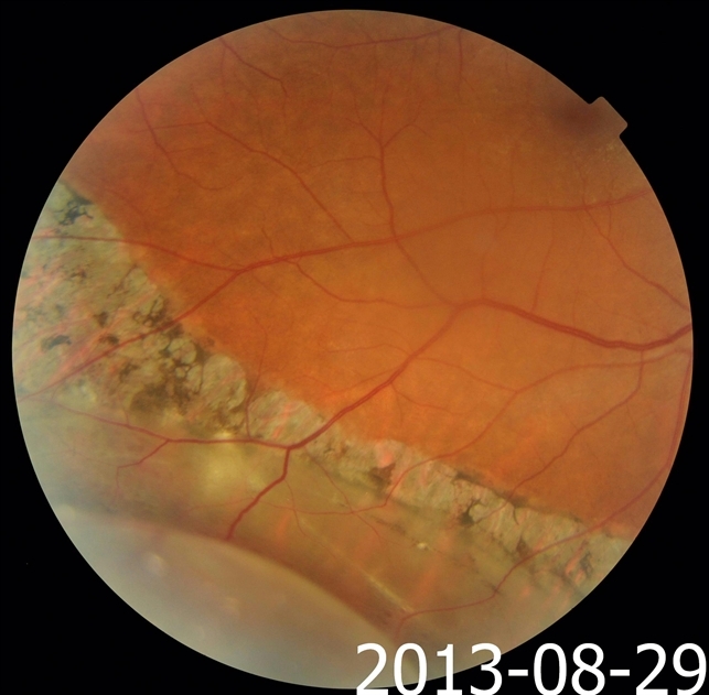 Pigmented Demarcation Line And Retinal Macrocyst Pigmented Demarcation Line And Retinal Macrocyst