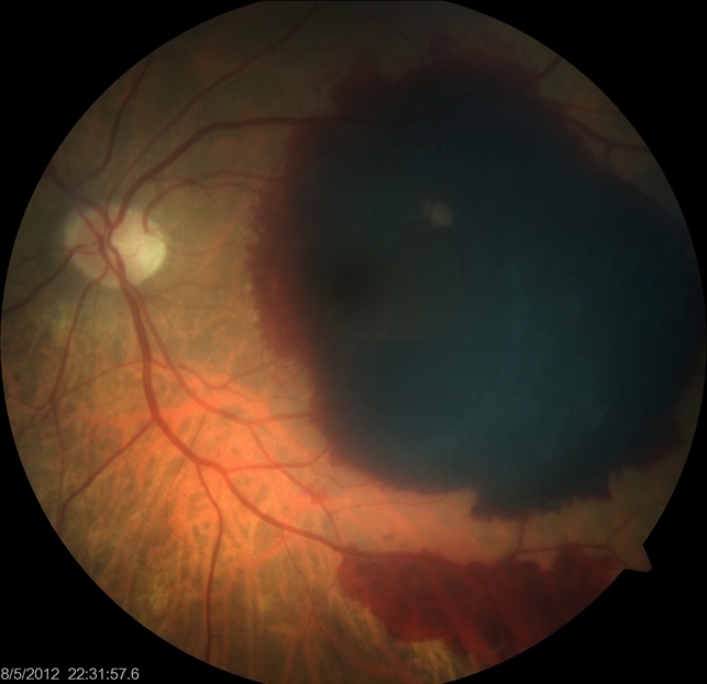 AMD With Subretinal Hemorrhage Recurrence OS AMD With Subretinal Hemorrhage Recurrence OS