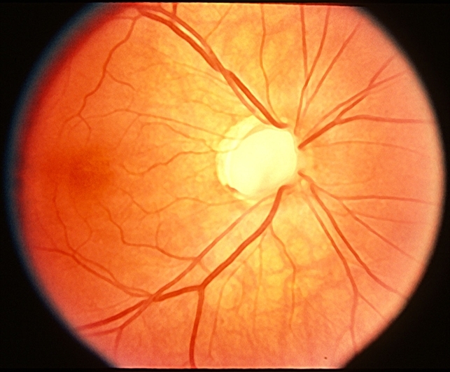 Optic coloboma nerve file probable imagebank asrs Probable Optic Nerve Coloboma - Retina Image Bank