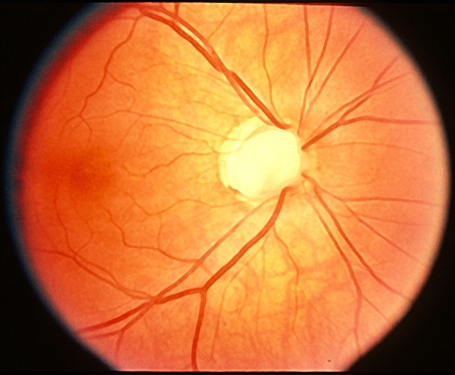 Probable Optic Nerve Coloboma - Retina Image Bank