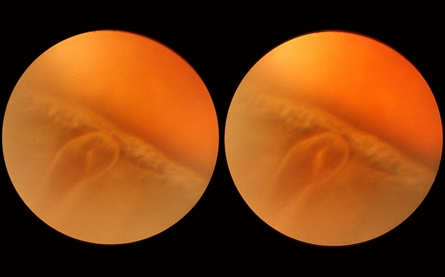 Cyst of the Pars Plana - Retina Image Bank