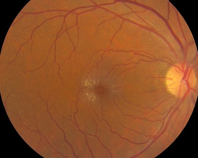 Parafoveal telangiectasis acquired file retina imagebank Crystaline Deposits in Parafoveal Telangiectasis - Retina Image Bank