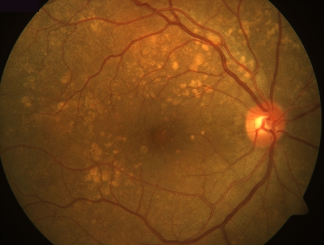Age-related macular degeneration Age-related macular degeneration