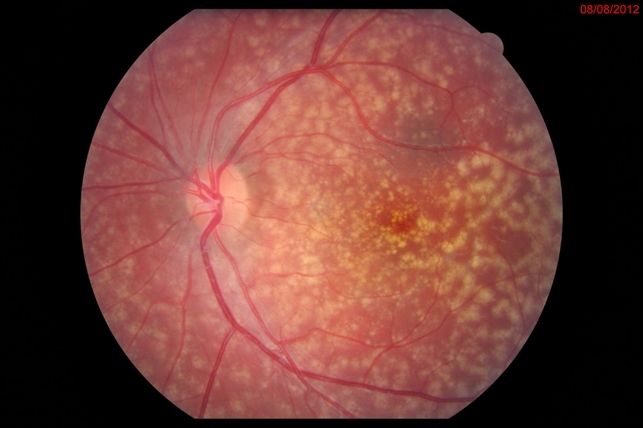 Familial drusen le Familial drusen LE - Retina Image Bank