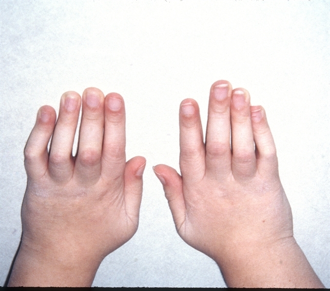 blau syndrome pictures, photos