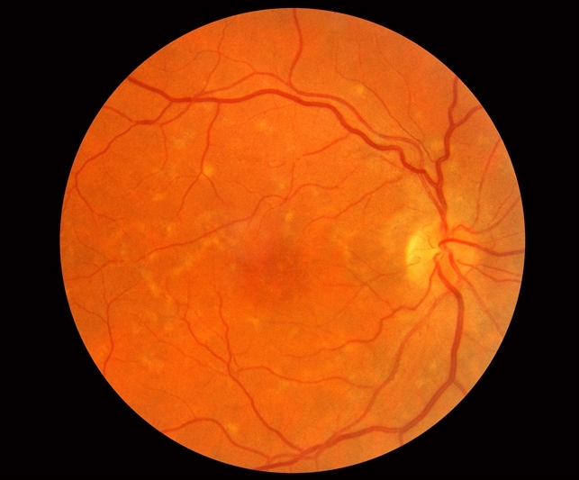 Pattern Dystrophy slide 1 Retina Image Bank