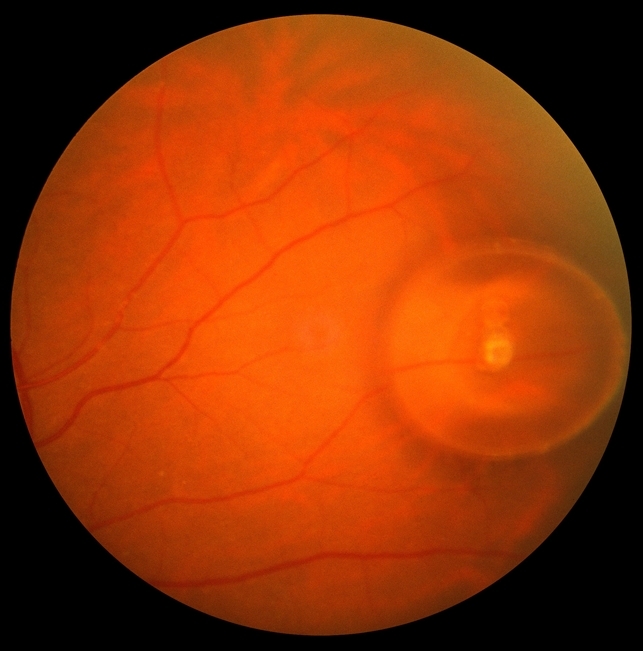 trapped-subretinal-gas-bubble-retina-image-bank