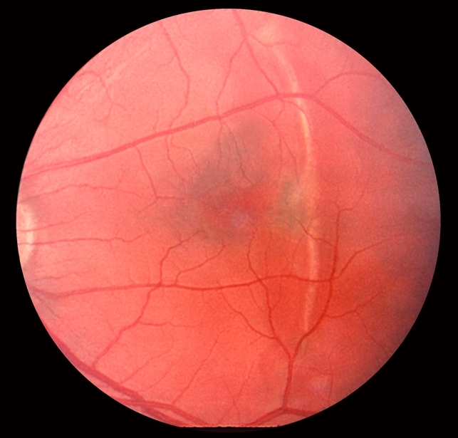 Choroidal Rupture Across Macula Choroidal Rupture Across Macula