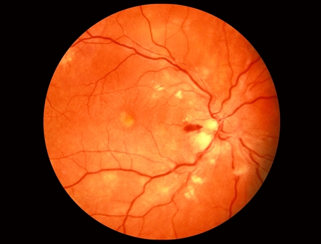 malignant-hypertension-retina-image-bank