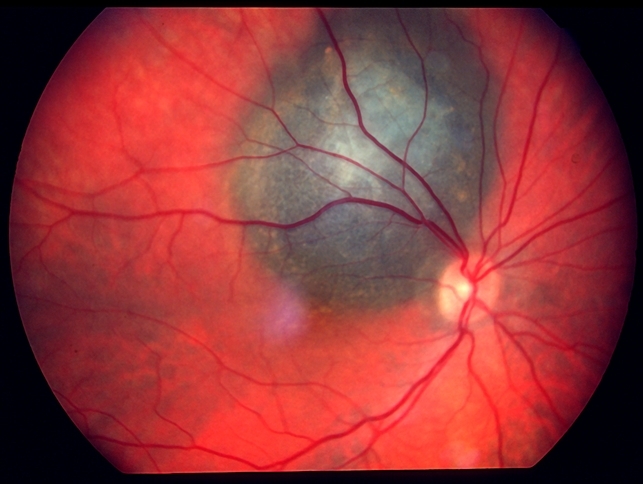 Melanoma of the retina