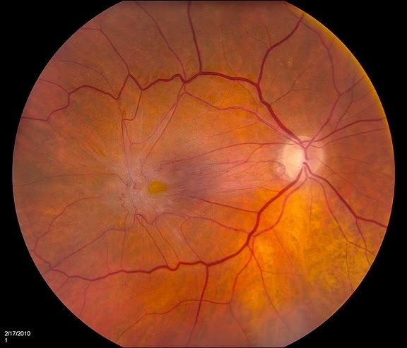 Macular Pucker - Retina Image Bank