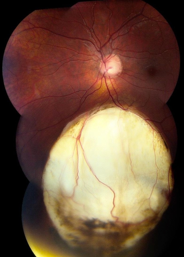 Retinal Coloboma - Retina Image Bank