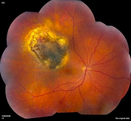 ocular melanoma pictures