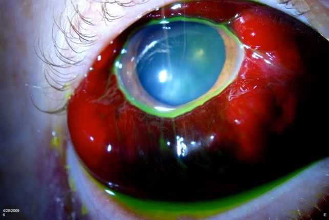 Sub-Conjunctival Hemorrhage (Chemosis) - Retina Image Bank