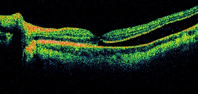 macula-off-rhegmatogenous-retinal-detachment-retina-image-bank