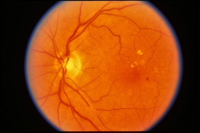 hypertensive retinopathy