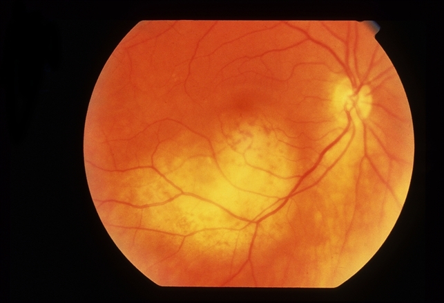 Amelanotic Malignant Melanoma Retina Image Bank