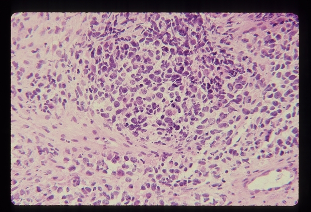 Rhabdomyosarcoma R Orbit - Retina Image Bank