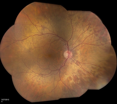 icd 10 code for peripheral retinal degeneration