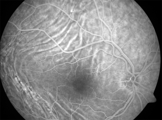 Idiopathic Choroidal Folds Idiopathic Choroidal Folds