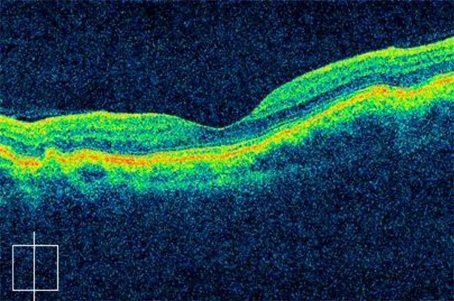 Bilateral Idiopathic Choroidal Folds Bilateral Idiopathic Choroidal Folds