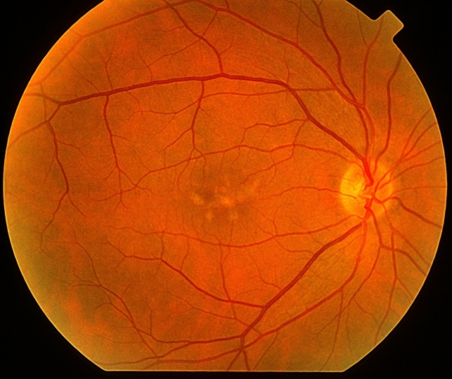 Pattern Dystrophy Retina Image Bank
