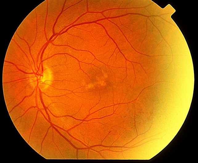 Pattern Dystrophy Retina Image Bank