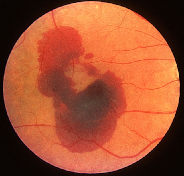 Age-related macular degeneration Age-related macular degeneration
