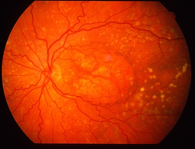 Age-related macular degeneration Age-related macular degeneration