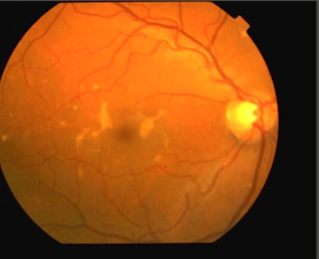 Pattern Dystrophy Simulating Fundus Flavimaculatus 2 Retina Image Bank