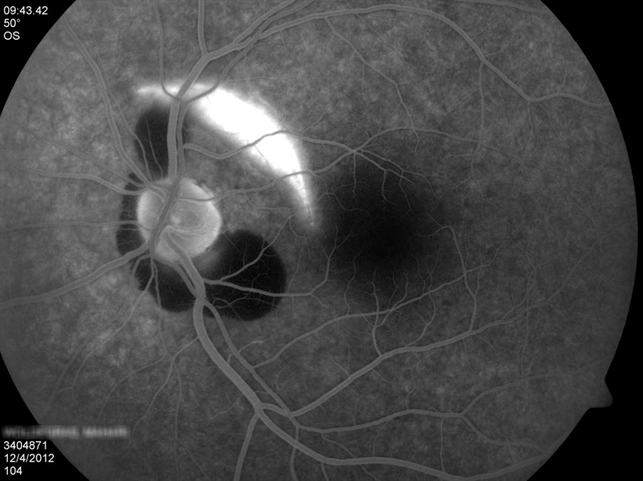 Choroidal Rupture And Peripapillary Hemorrhage Choroidal Rupture And Peripapillary Hemorrhage
